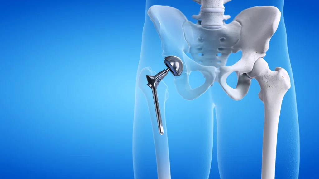 Modern Hip Replacement Designed for Comfort, Mobility, and Confidence