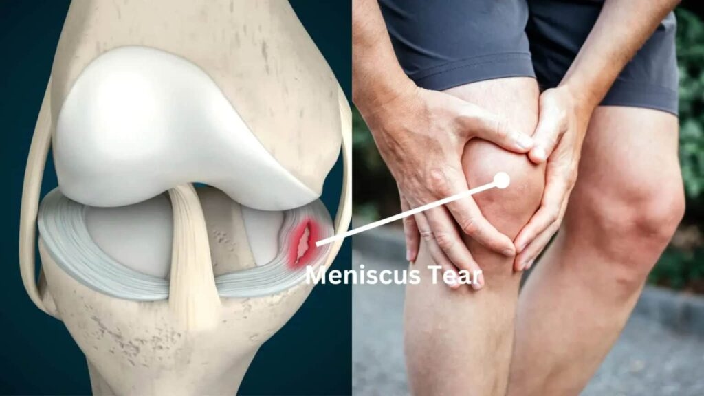Meniscus Tears