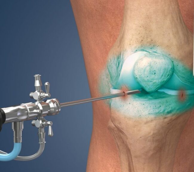 How is arthroscopy performed?