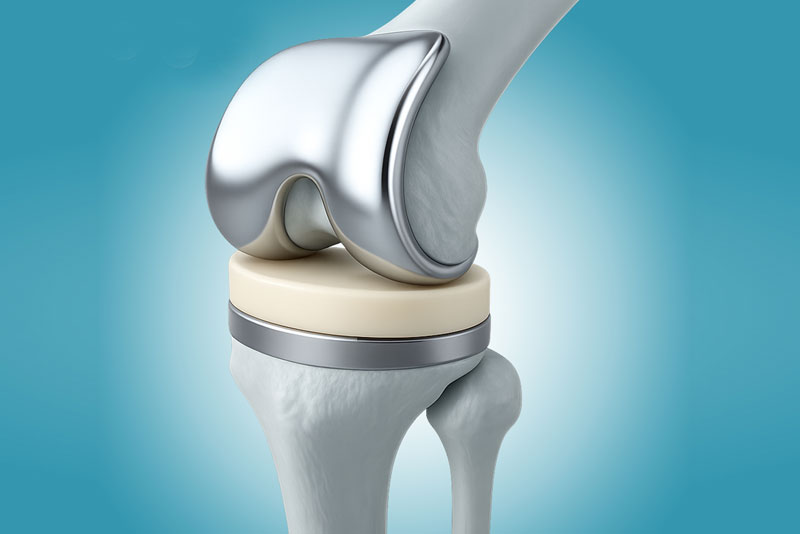 Total Knee Replacement