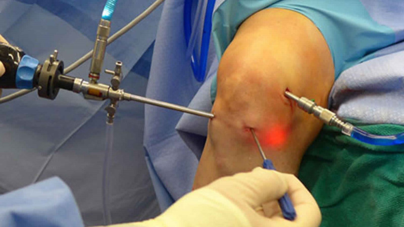 Arthroscopy