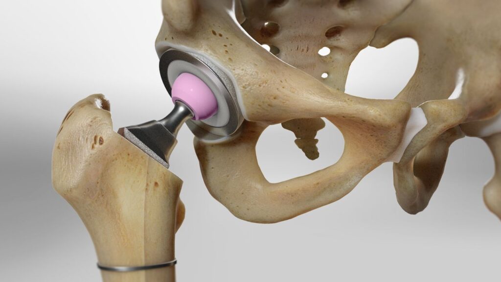 What Is Total Hip Replacement?
