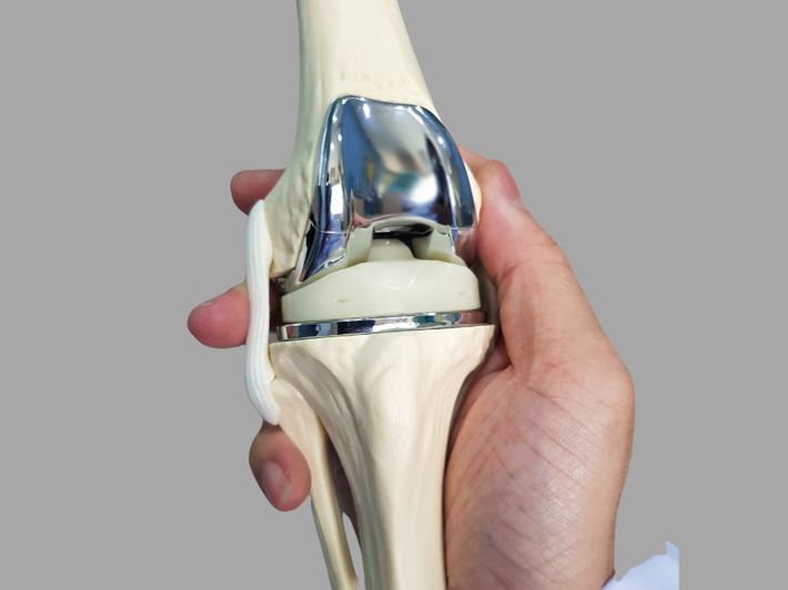 How Total Knee Replacement Works