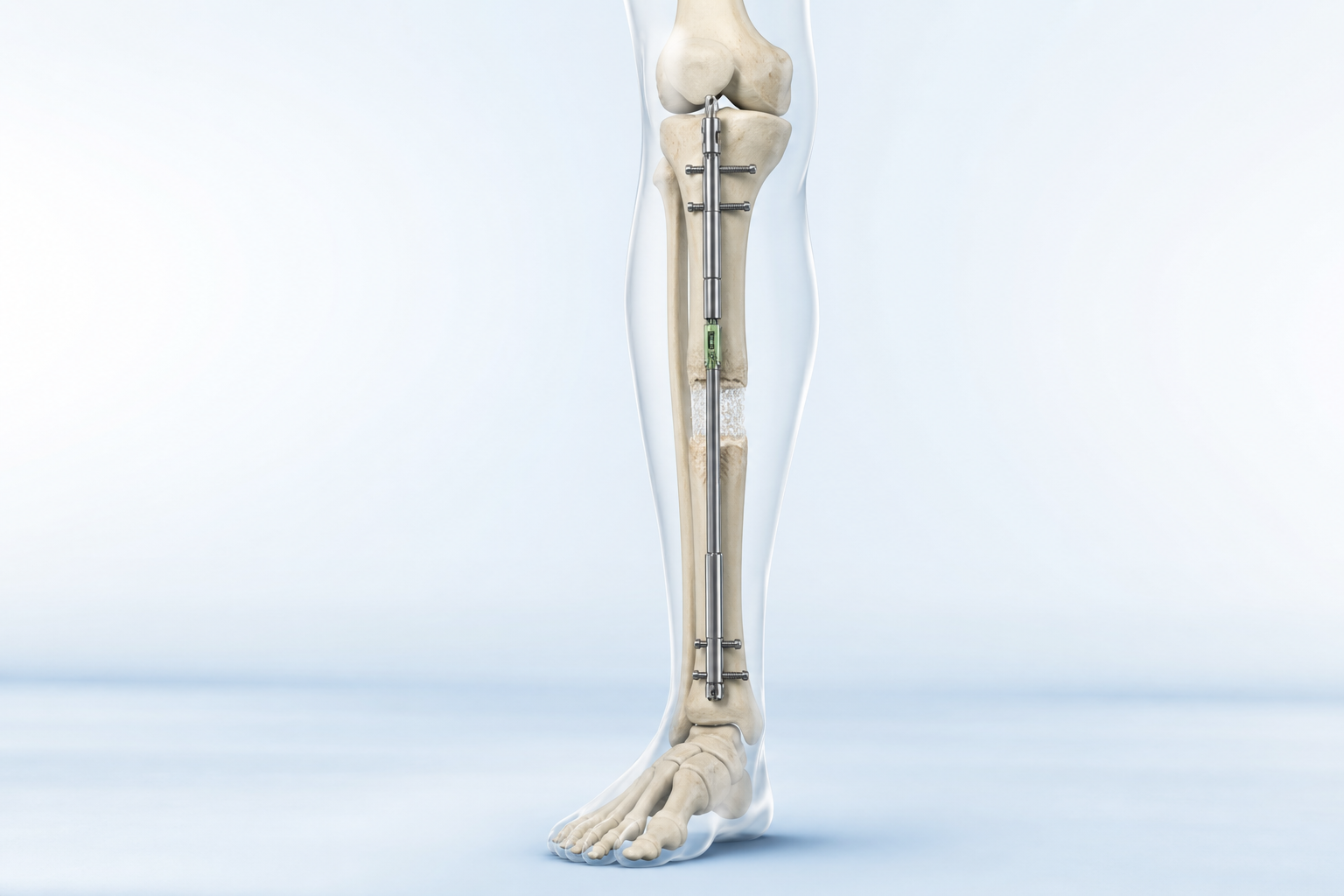 Limb Lengthening